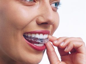 studio smiles alpignano invisalign